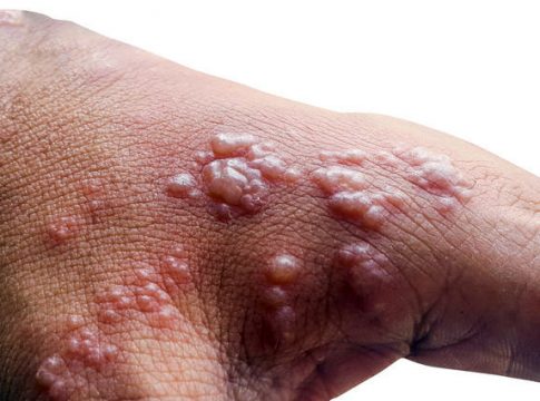 Skin infected Herpes zoster virus on the arms
