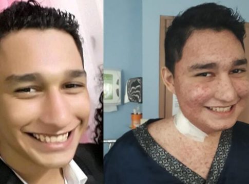 Jovem precisa de remédio caro para tratar doença autoimune