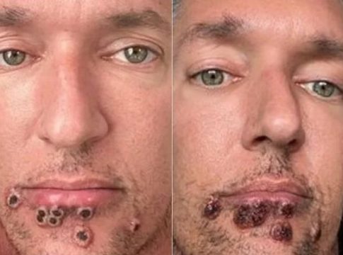 Com varíola, ator pornô mostra evolução das feridas no rosto