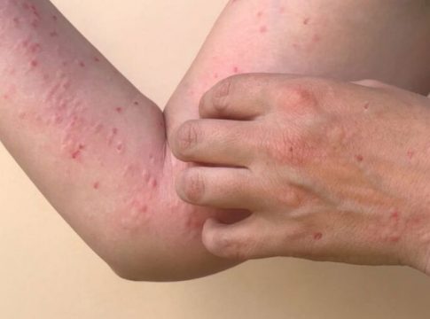 Belém tem três casos de transmissão local da nova varíola