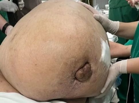 Mulher que teve tumor de 46 kg removido morre no RJ