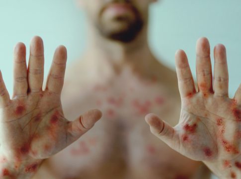 Belém lidera casos de Monkeypox. Foto: Divulgação