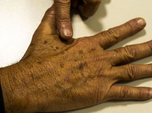 Câncer de pele é o de maior incidência no Brasil
