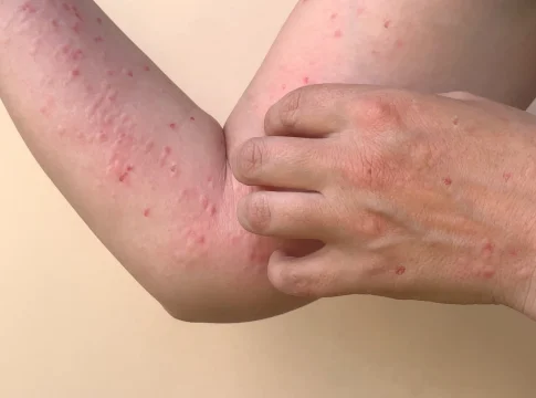 Segundo a Sespa, há 10 casos suspeitos seguem em investigação, residentes de: Belém (06), São Miguel do Guamá (01), Santarém (01), Ananindeua (2). Foto: Divulgação