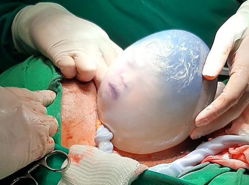 Trata-se de uma forma rara de nascimento, onde o bebê permanece dentro da bolsa amniótica durante o parto – sem que haja seu rompimento. Foto: Divulgação