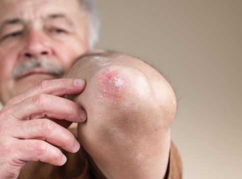 No Brasil, o dia 29 de janeiro foi instituído como Dia Nacional de Combate e Prevenção à Hanseníase, dando ainda mais ênfase ao trabalho preventivo. Foto: Divulgação