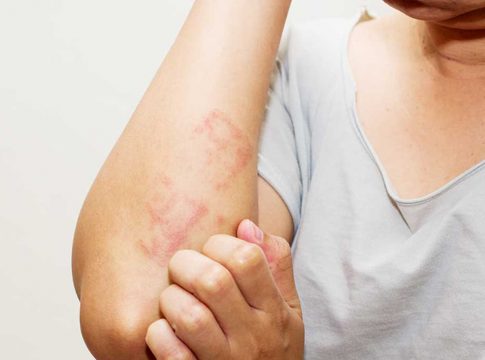 a requerente tem dermatite atópica grave, apresentando lesões extensas na pele, já tendo se submetido a diversos tratamentos medicamentosos sem que tenha obtido o resultado terapêutico esperado. Foto: Divulgação