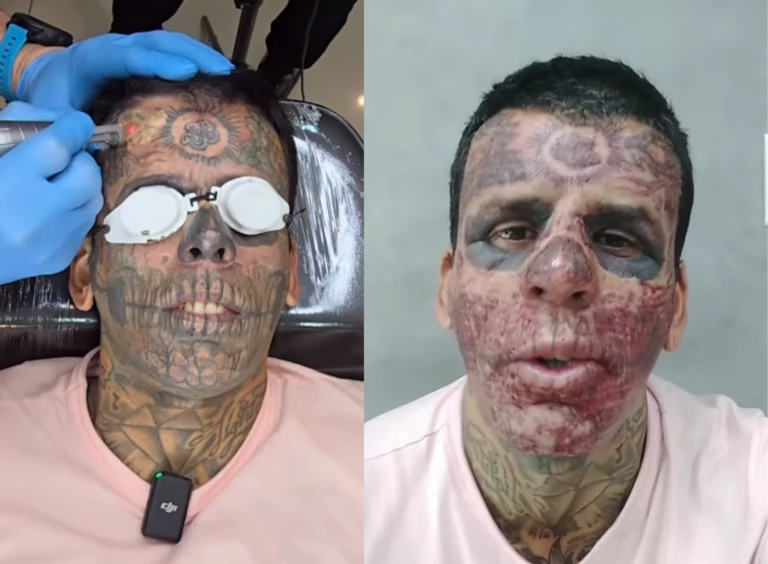 O laser fragmenta o pigmento da tatuagem para que o organismo o elimine gradualmente mediante processos naturais, como urina e suor.